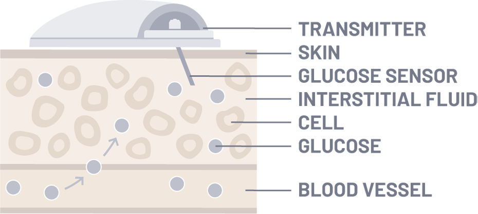 How it works glucose monitoring device
